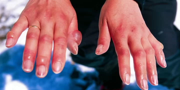 Cuaca Dingin Bisa Akibatkan Orang Terkena Frostbite