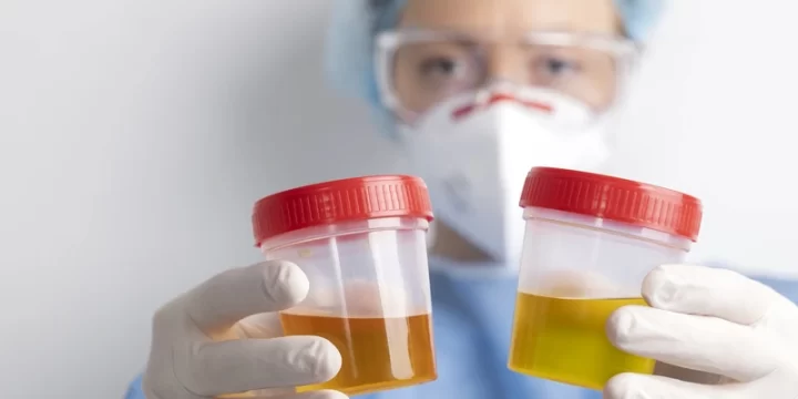 Apa Itu Penyakit Hematuria, Bagaimana Penanganannya?