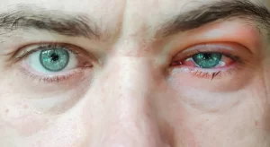 Mata Buram Sesaat Usai Berkedip, Gejala Penyakit Dry Eye 1 Mata Buram Sesaat Usai Berkedip, Gejala Penyakit Dry Eye