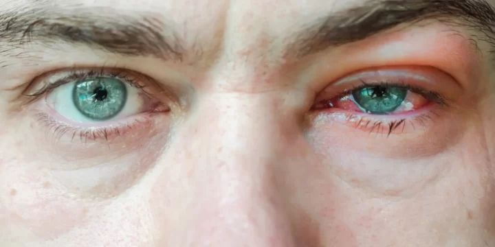 Mata Buram Sesaat Usai Berkedip, Gejala Penyakit Dry Eye