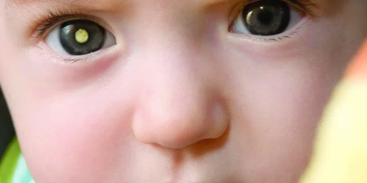 Waspadai Leukimia dan Kanker Retina Mata Pada Anak
