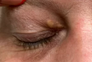 Apa itu Xanthelasma? Ini Penjelasannya 1 Apa itu Xanthelasma