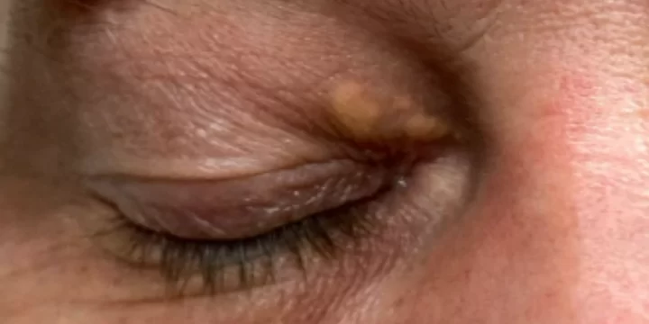 Apa itu Xanthelasma? Ini Penjelasannya