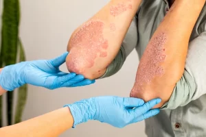 Kenali dan Atasi Sakit Psoriasis Secara Sederhana 1 Kenali dan Atasi Sakit Psoriasis Secara Sederhana