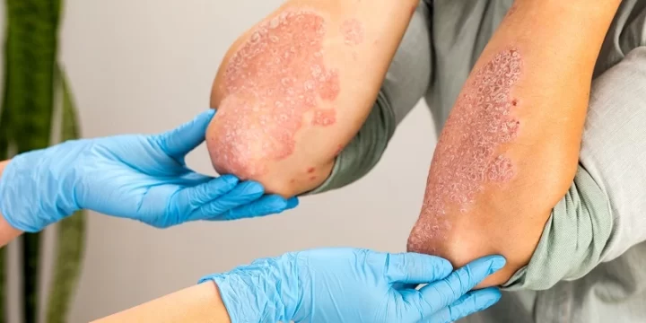 Kenali dan Atasi Sakit Psoriasis Secara Sederhana