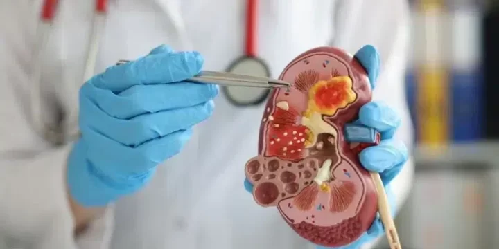 Sering Tak Bergejala, Ini Ciri-ciri Kanker Ginjal