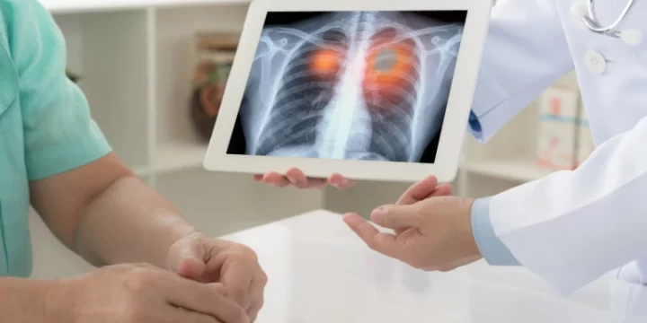 Perawatan Kanker Paru-Paru di Rumah, Bisa Dilakukan Sendiri!